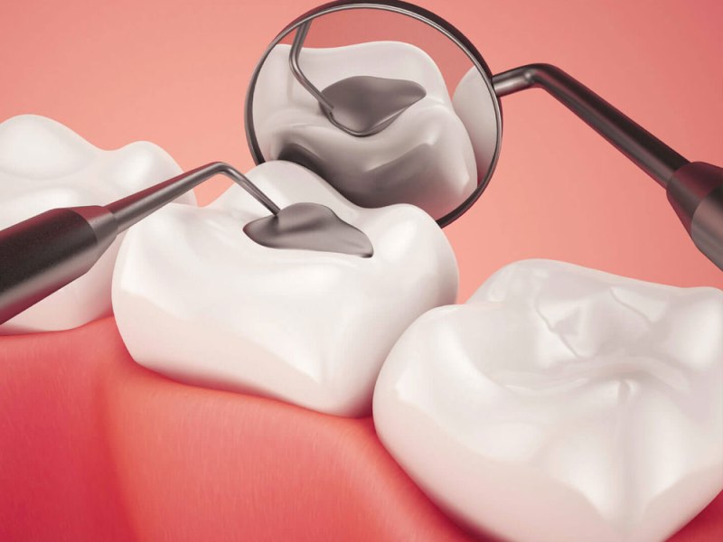 Dental fillings: everything you need to&nbsp;know
